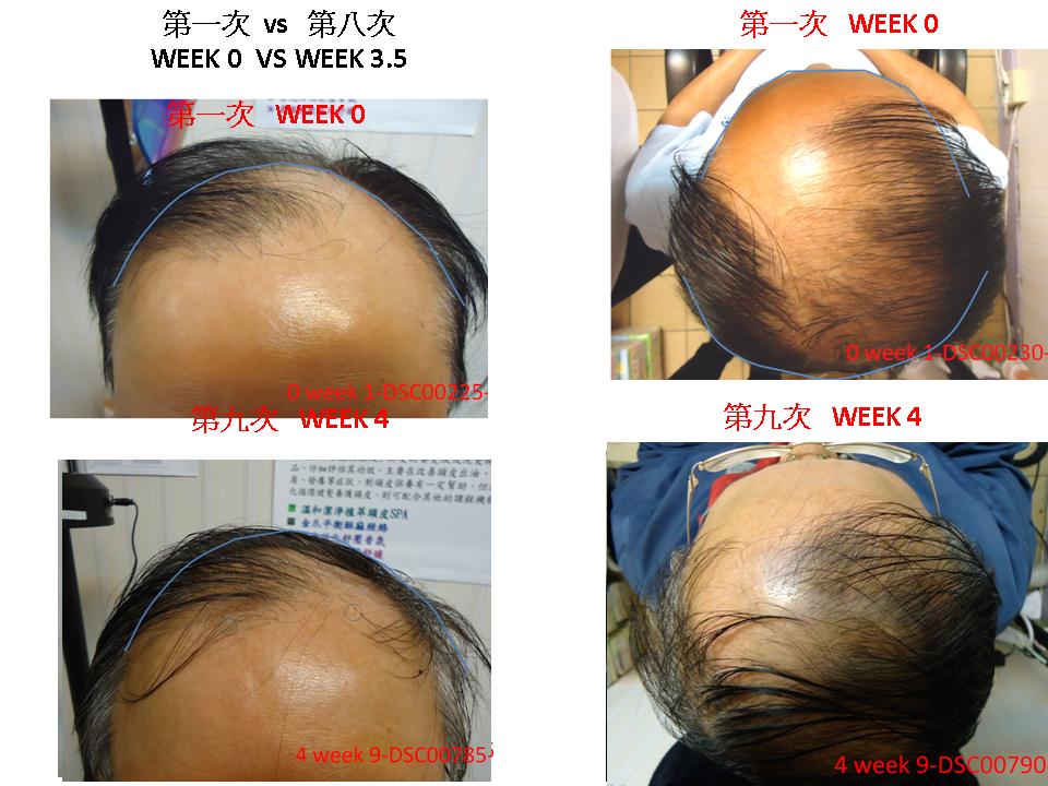 TREATMENT FOR FRONTAL HAIR LOSS TOP HAIR REGROWTH USEFUL OR NOT ?