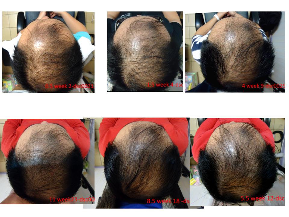 alopecia frontal hair loss top hair regrowth?