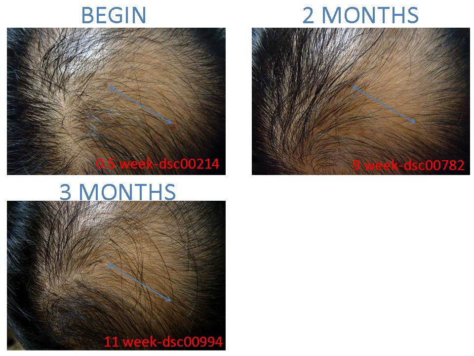 alopecia frontal hair loss top hair regrowth? detail