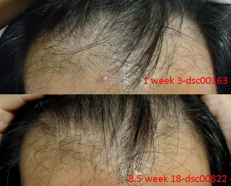 alopecia frontal hair loss top hair regrowth? detail