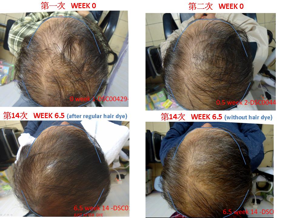 alopecia top hair loss or hair regrowth useful?