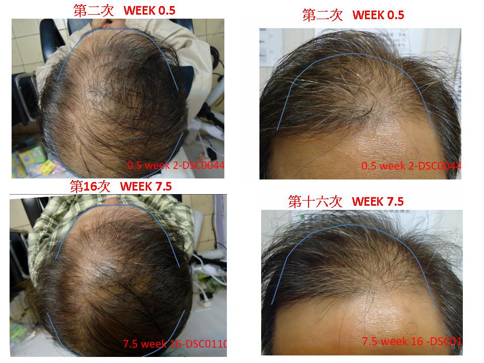 frontal hair regrowth or top hair loss alopeica or bladness useful?