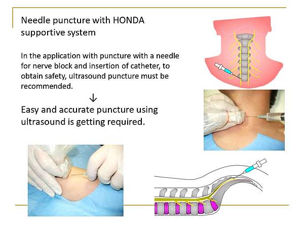 HONDA定位導引Tshaped彩色超音波 日製高階8.4吋 LCD彩色廣角螢幕 雙切面Echo-guided puncture穿刺引導 同時顯示橫/縱切面影像，執行PICC，CVC時正確抓到血管位置避開各神經。 專利T型探頭，配合定位引導器，進行更簡單精確的穿刺。 特別適合心導管檢查，CCU小血管穿刺定位，避免刺穿或失誤。 適合耳鼻喉，聲帶，鼻竇腔掃描及疼痛治療定位注射