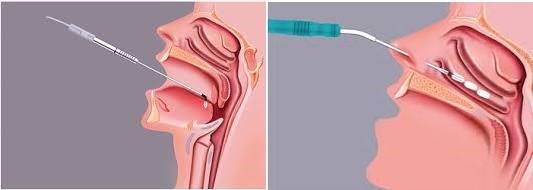 RF無線射頻電波ENT手術治療儀 RF無線射頻電波ENT手術治療儀