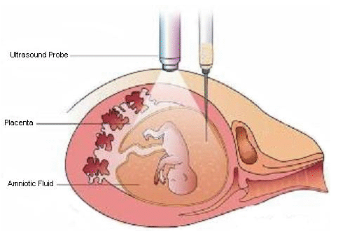 amniocentesis.gif