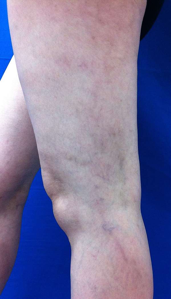 靜脈曲張治療後的色素沉著問題 Hyperpigmentation After Varicose Vein Treatment 陳建彰醫師的部落格 痞客邦