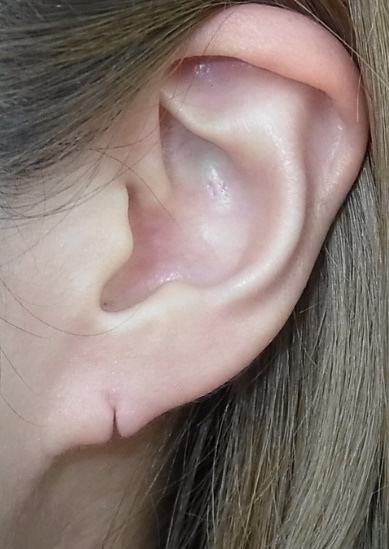 耳垂撕裂修復 Ulthera音波拉皮 Cpt電波拉皮 Filler Lift注射式拉皮 Loop縫合式雙眼皮 Skin Redraping開眼頭眼尾 Tc Levator經結膜提眼肌 Tclb經結膜眼袋脂肪移位 Bistool鼻整形 Inframammary Dpba 400ml以上隆乳