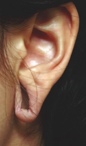 torn earlobe1