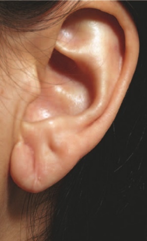 torn earlobe2