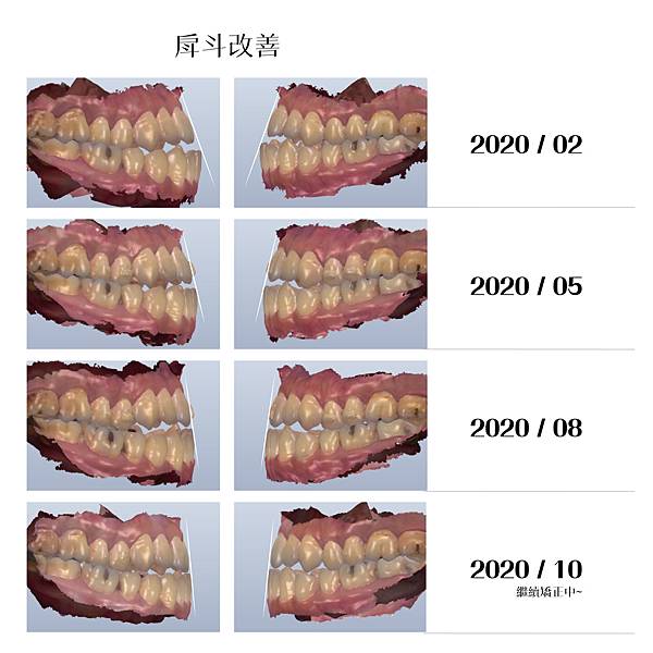 林伯剛 矯正案例分享_工作區域 1 複本