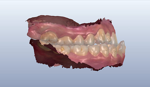 underbite 戽斗