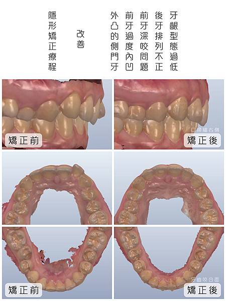 妤 矯正前後比對_工作區域 1 複本 2