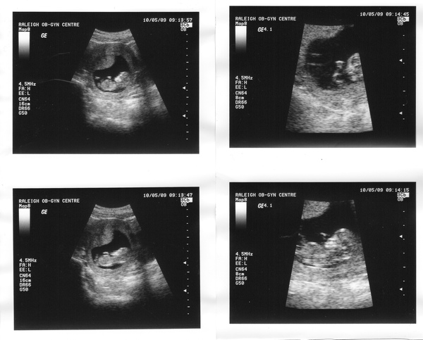 11 Weeks_4cm.JPG