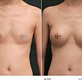 breast-case02-1