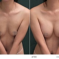 breast-case03-2