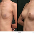 breast-case02-2