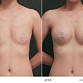 breast-case03-1