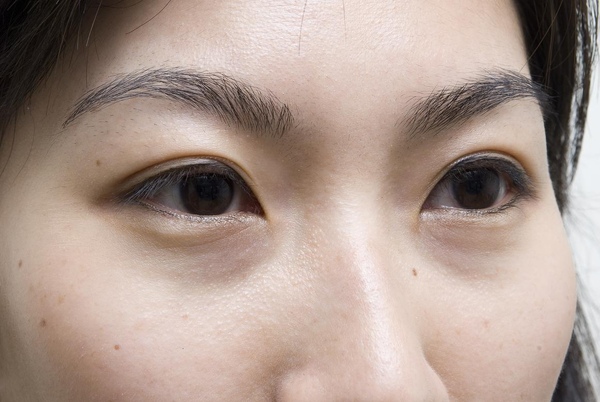 NG:明顯的淚溝,讓漂亮的眼睛失色!.JPG NG:明顯的淚溝,讓漂亮的眼睛失色!.JPG