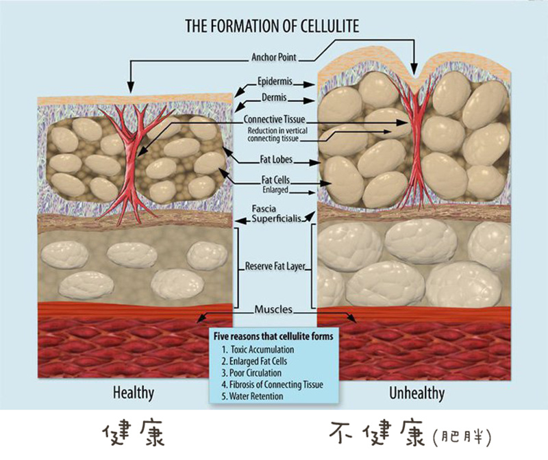 Formation_of_Cellulite.jpg