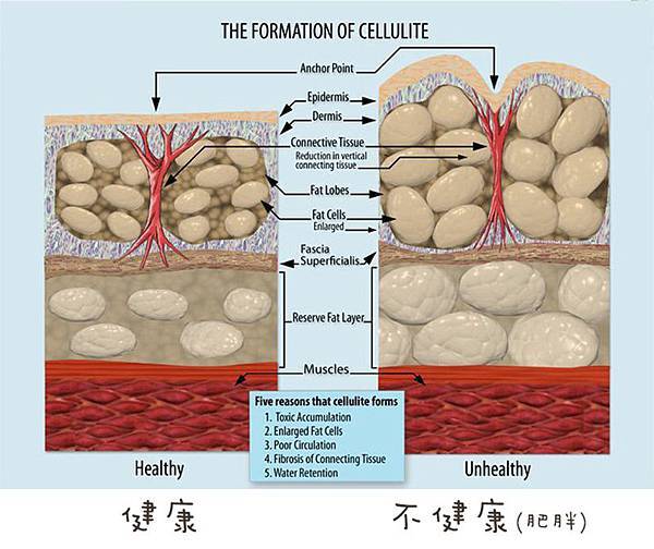 Formation_of_Cellulite.jpg