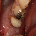 bfeore implant 1.jpg