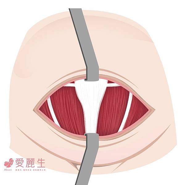 剖腹產1222 剖腹產1222