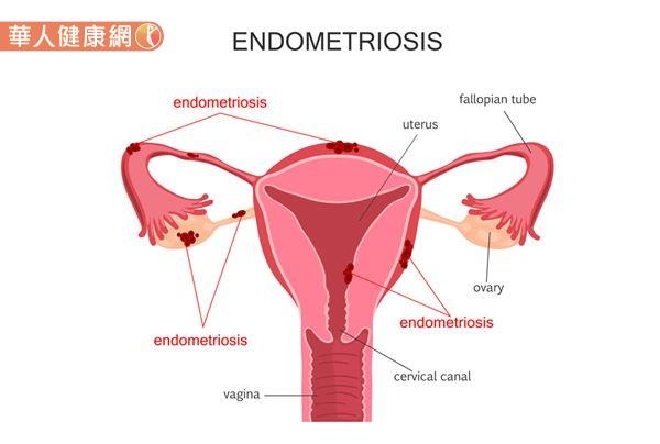子宮內膜異位指的是，本來該長在子宮內膜層，具有子宮內膜同樣功能的內膜組織，異常地生長在子宮內膜層以外地方的一種症狀。
