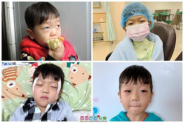 斜視開刀 (1).jpg