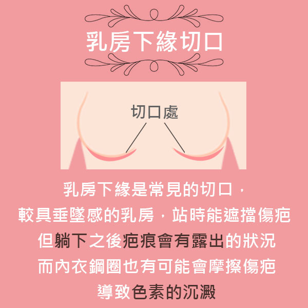 艾美零距離-乳房下緣切口.jpg