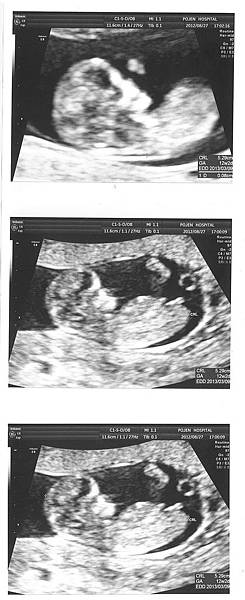 11W6D