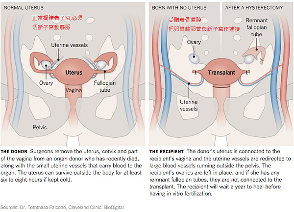 uterus-transplant.png