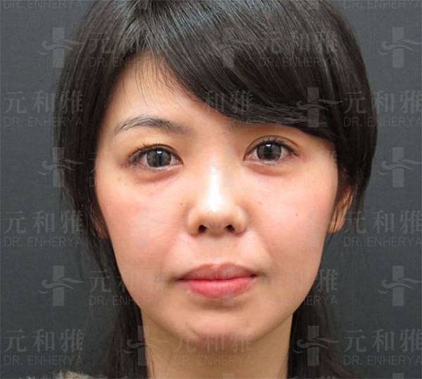墊下巴手術前 墊下巴手術前