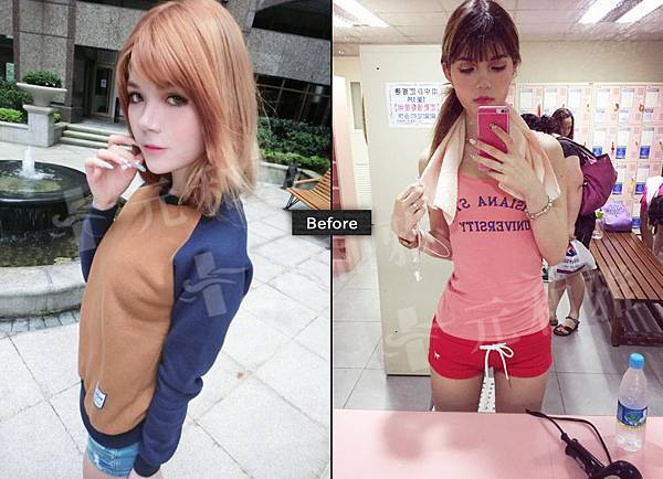 果凍矽膠隆乳11 果凍矽膠隆乳11