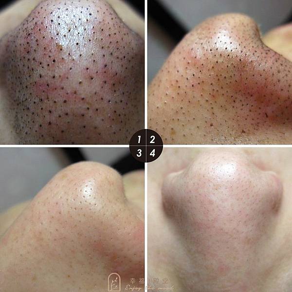 關於「粉刺」的問題