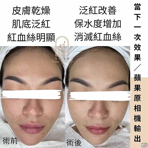 酒糟肌膚可以做臉嗎?