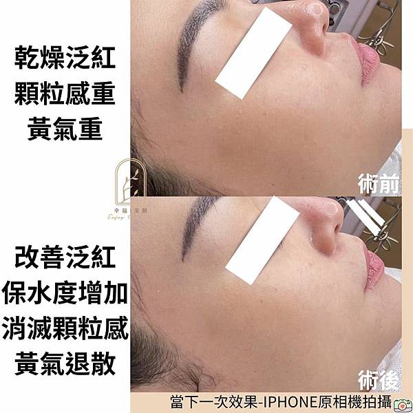 酒糟肌膚可以做臉嗎?