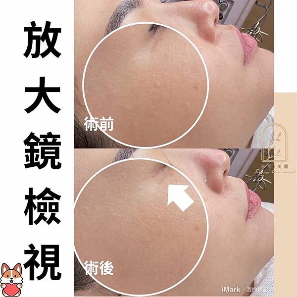 酒糟肌膚可以做臉嗎?