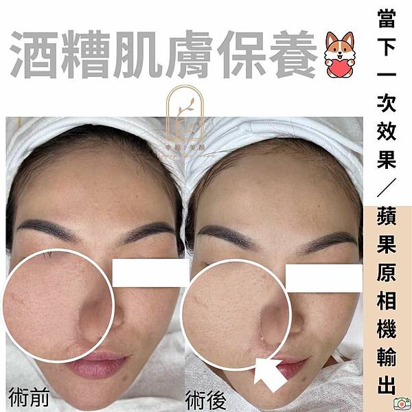 酒糟肌膚可以做臉嗎?