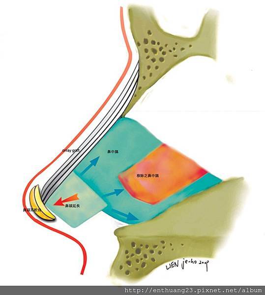 rhinoplasty