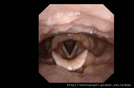 chronic-pharyngitis-1.jpg