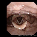 chronic-pharyngitis-1.jpg