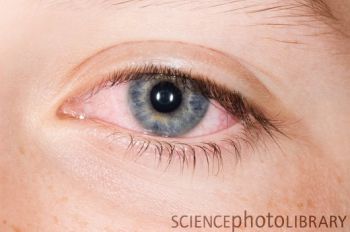 C0090101-Adenoviral_conjunctivitis_of_the_eye-SPL