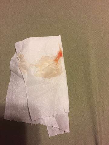 連續兩個月天天見血 懷孕初期出血 Amber的探索之旅 痞客邦