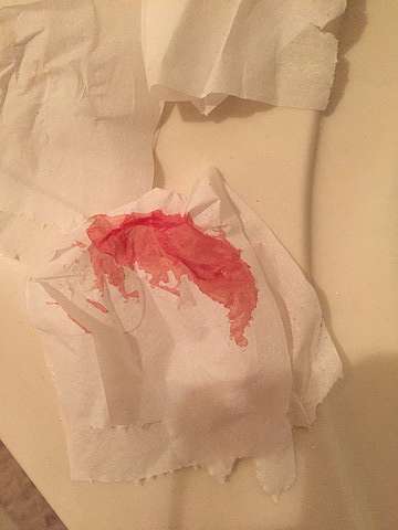 連續兩個月天天見血 懷孕初期出血 Amber的探索之旅 痞客邦