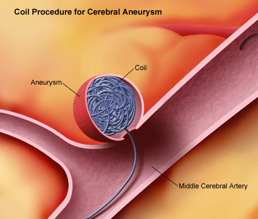 GS_coil procedure cerebral aneurysm_lg.gif
