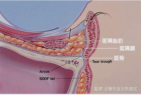 眼袋手術說明