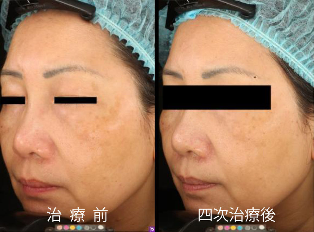 超皮苗-17.jpg 超皮苗-17.jpg