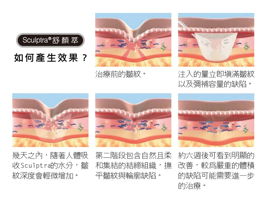 Sculptra1-01.jpg Sculptra1-01.jpg