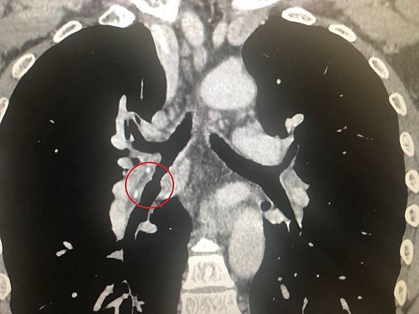 圖說1-1：長安醫院胸腔科姚智偉醫師(右)表示，經肺部電腦斷層可見患者右邊肺部有一支氣管較為狹窄(紅圈處)，後續經支氣管鏡檢查，診斷為「類澱粉沉積症」。.jpg