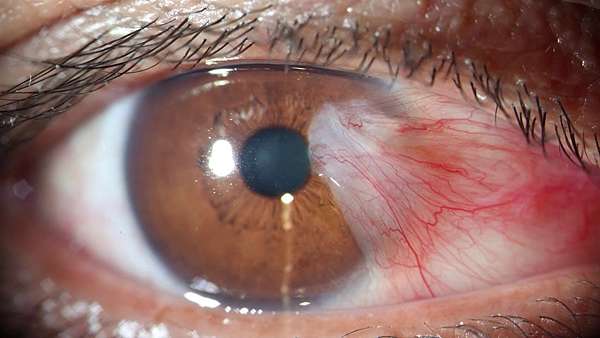 眼科疾病 翼狀贅肉 Pterygium 眼科廖家慶醫師 眼部整型 近視雷射 屈光手術 Transprk Lasik 痞客邦